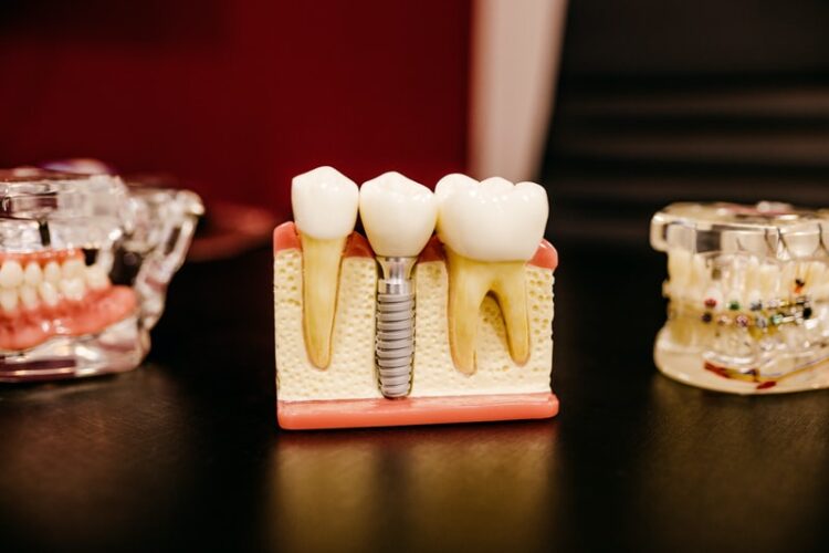 Kur implantuotis dantis Klaipėdoje?